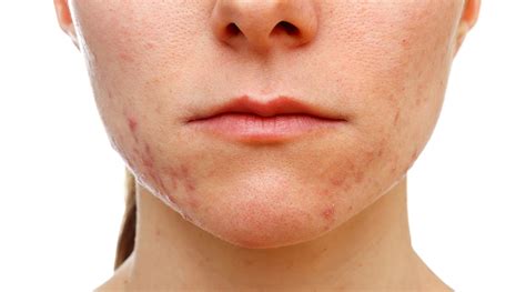 Acne Marks vs Acne Scars: Differences & Treatments | Sozo Clinic