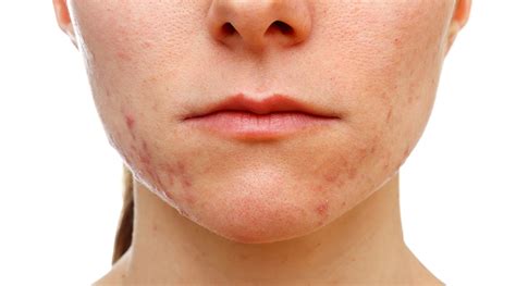 Acne Marks Vs Acne Scars Differences And Treatments Sozo Clinic