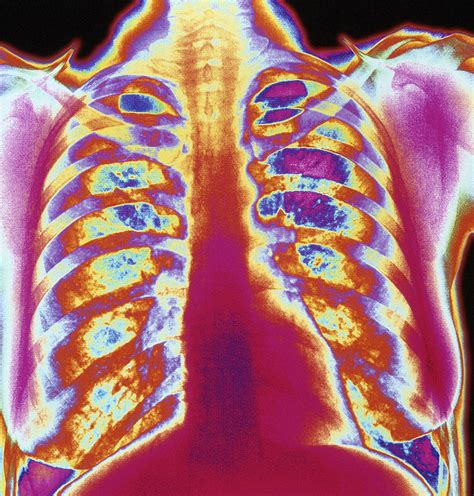 Coloured Chest X Ray Of A Healthy Woman Photograph By Mehau Kulyk Pixels