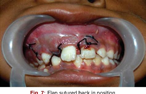 Figure 7 From Anterior Maxillary Dentigerous Cyst Semantic Scholar