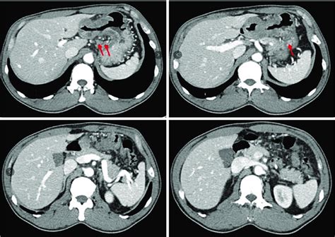 The Abdominal Enhanced Ct Scanning Showed The Significantly Diffused