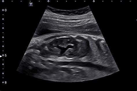 Normal Fetal Kidney Ultrasound