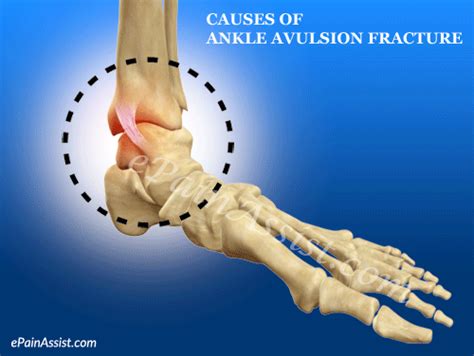 Ankle Avulsion Fracture Symptoms Causes Treatment Recovery Time Exercises