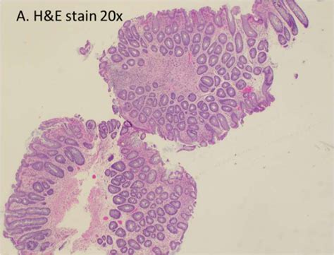 Solitary Rectal Ulcer Syndrome With Polyposis Consultant360