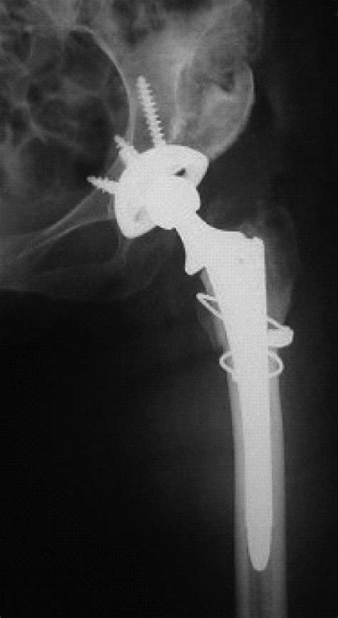 Cementless Total Hip Replacement With Subtrochanteric Femoral