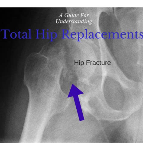 Total Hip Replacement Rehab Tips From A Physical Therapist