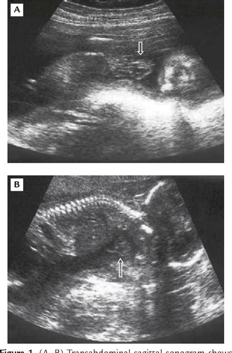 Figure 1 From Prenatal Diagnosis Of Ectopia Cordis Semantic Scholar