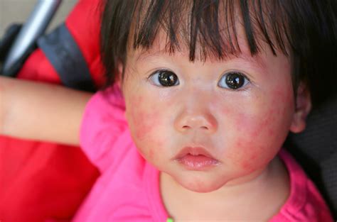 Biang keringat di leher sembuh setelah diberi salep, eh cuaca semakin nggak mendukung. Cara Menghilangkan Biang Keringat Di Wajah Pada Bayi ...