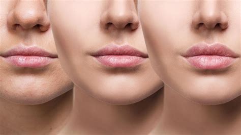 Best Lips Augmentation In Delhilip Fillerslip Injection Dermaworld