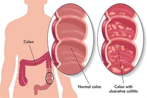 Schematic Of A Normal Colon Versus A Colon With A Colitis Ulcer 1
