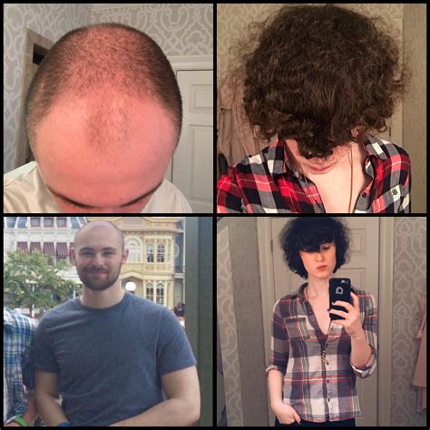 A Quick Before And After To Show The Potential For Hair Regrowth On Transfemme Hrt 2 Years 22y