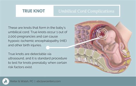 True Knot In Umbilical Cord Risk Factors Signs Diagnosis And Treatment Nursing School