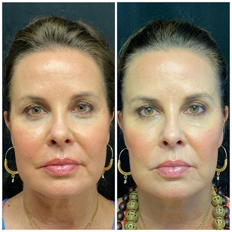 Patient 8693710 Evoke Radiofrequency Before And After Photos Austin