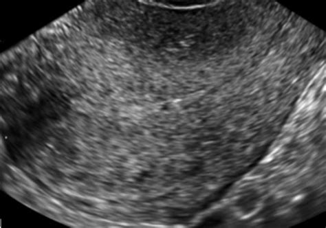 Sonography Of Adenomyosis Sakhel 2012 Journal Of Ultrasound In