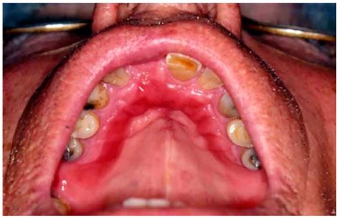 Ijerph Free Full Text Management Of Chronic Atrophic Candidiasis