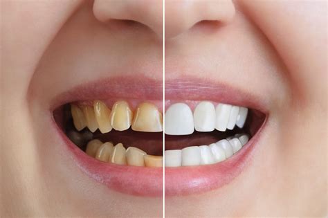 ¿cuáles Son Nuestros Tratamientos En Estética Dental Clínica Dental