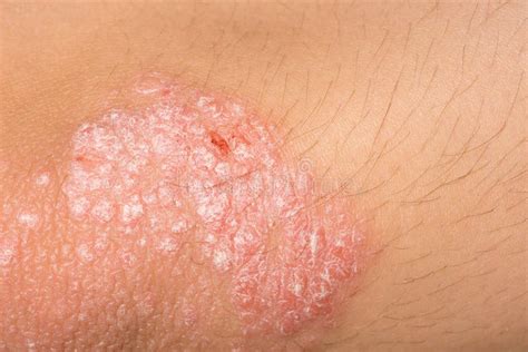 Eczema Closeup Stock Image Image Of Reaction Male Sclerosis 3866263