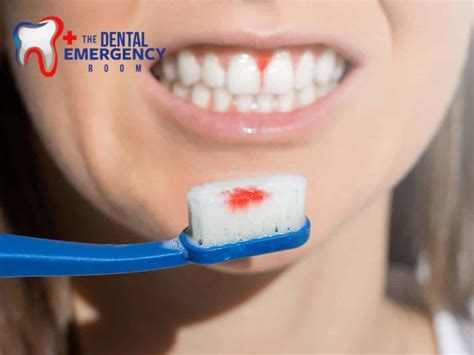 How To Treat Periodontitis Causes Symptoms Treatment