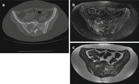Imaging Of Sacral Tumors Experience Of The Rizzoli Institute