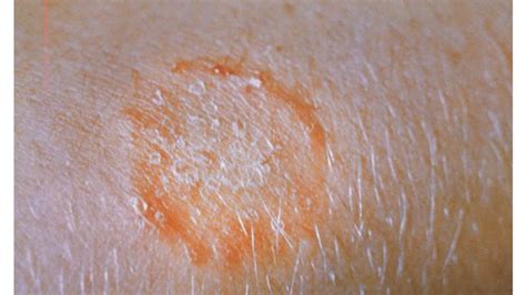 Ringworm Look Alikes Circular Rash Causes And Diagnosis A Host Of