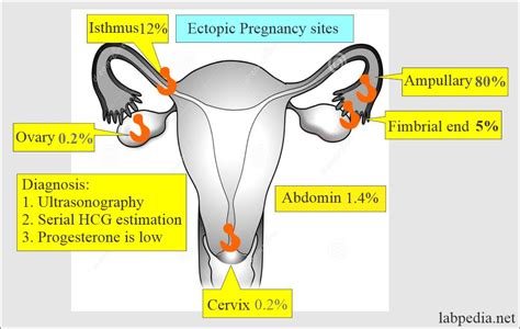 Ectopic Pregnancy And Its Diagnosis Labpedia Net