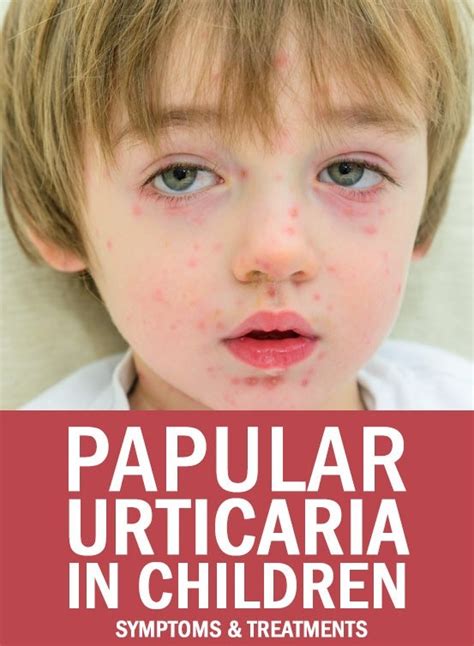 Papular Urticaria Signs And Symptoms And Treatment