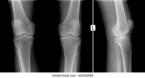 Xray Knee Joints Fracture Medial Condyle Stock Photo 665542084