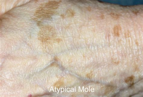 Atypical Mole Melanoma Skin Cancer