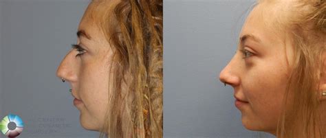 Some Known Facts About Rhinoplasty Nose Surgery In Birmingham