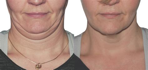 Strawberry Lift Double Chin Reduction Treatment Laser Face Lift