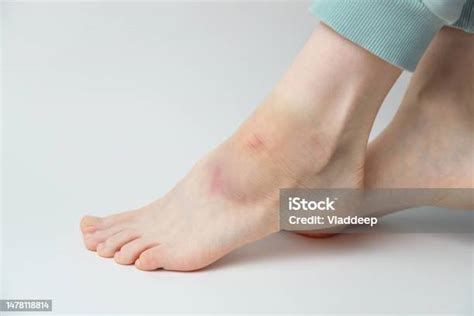 Sprained Ankle With Bruise And Swelling On A Female Left Foot On White