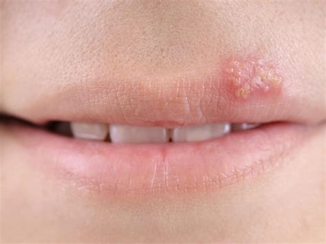 Opryszczka Na Ustach Przyczyny Objawy Leczenie Pieknojestwtobie Com Sexiz Pix