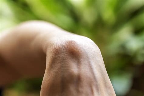 What Doctors Wish You Knew About Ganglion Cysts The Healthy