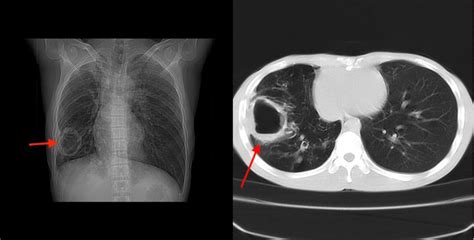 Chest Ct Scan Showed Massive Cavity In The Right Lower Lobe Taken On