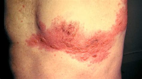 Rash On Chest Pictures Causes Symptoms Remedies And