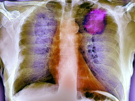 Lung Cancer X Ray Stock Image M1340579 Science Photo Library