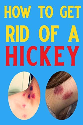 how to get rid of hickies asap teachfuture6