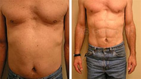 Abdominal Etching Provides A Six Pack Without The Exercise