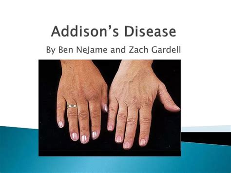 Ppt Addisons Disease Powerpoint Presentation Id1412672