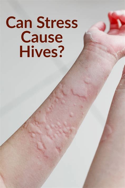 Real Life Experience What Is The Cause Of Hives Stress