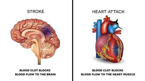 Avoid A Heart Attack Or Stroke 10 Foods To Never Ignore