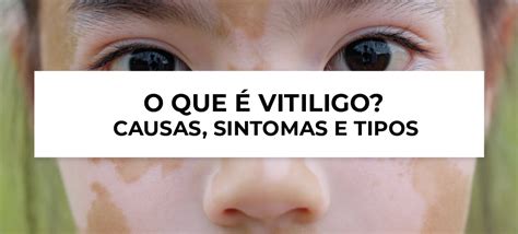 O Que É Vitiligo Causas Sintomas E Tipos Blog Ada Tina