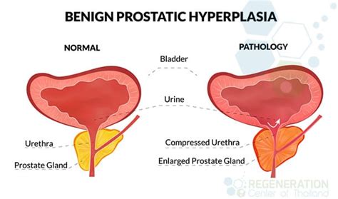 Stage 0 to 1 is a tumor just starting out. Immunotherapy & Stem Cells for Treating Prostate Cancer