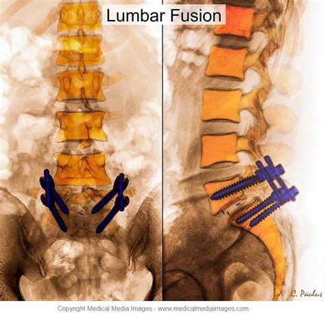 Color X Ray Medical Images Of A Front Anterior And Side Lateral View Of A Lumbar Fusion