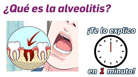 45 ¿qué Es La Alveolitis ¡te Lo Explico En Un Minuto Youtube