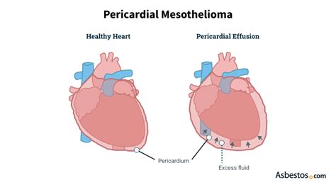 Pericardial Effusion List Of Causes And Treatment Steps