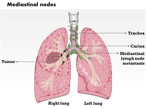 0714 Mediastinal Nodes Medical Images For Powerpoint Ppt Images