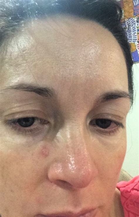 Skin Cancer On Face What Does It Look Like