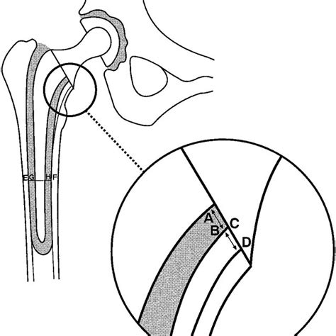 Diagram Of A Total Hip Replacement Showing The Position Of The