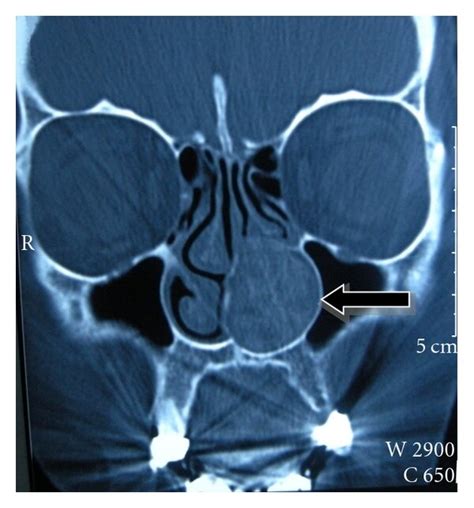 Paranasal Sinus Computed Tomography Coronal Section Showing The Bonny